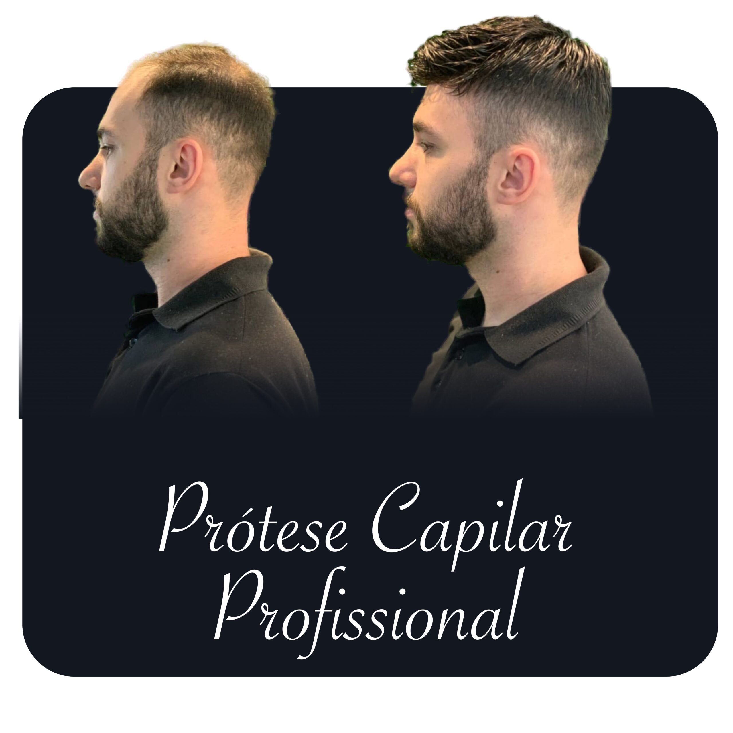 Prótese Capilar Profissional